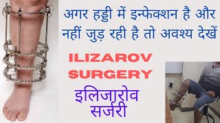 Ilizarov Surgery for bone infection and gap nonunion हड्डी के न जुड़ने और इन्फेक्शन का इलाज इलिजारोव [upl. by Melodie659]