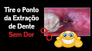 Como Tirar os Pontos do Dente Sozinho em Casa  Extração Dentária [upl. by Suiramaj]