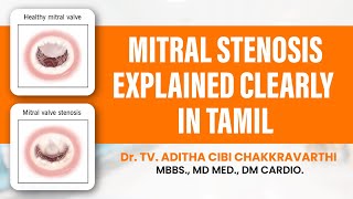 Mitral Stenosis Explained in Tamil [upl. by Sari]