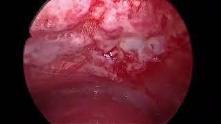 Rigid Thoracoscopy  Pleural Biopsy  Talc Poudrage  Malignant Pleural effusion [upl. by Gwyneth]