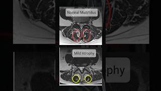 How to check Multifidus muscle in MRI [upl. by Mahda]