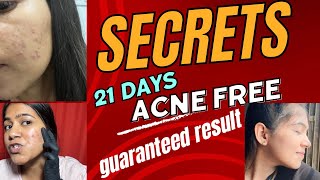 21 Days Acne Removal Challenge Guaranteed Result  Pimple Treatment  Skin Care Products [upl. by Ettelegna]