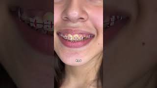 Braces Colors Before and after 8 weeks [upl. by Watters343]