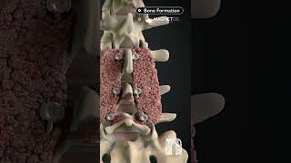 How MagnetOs can help you achieve a more predictable fusion  Medical Animation  MoA Animation [upl. by Laucsap]