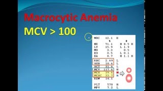 Hematology 2 Macrocytic Anemia [upl. by Eesdnyl]