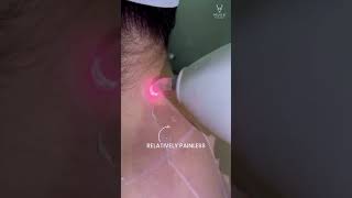 Laser hair removal mark for precision save target Area relatively painless [upl. by Ainegue]