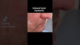 bilateral hemifacial myokymia [upl. by Adran]