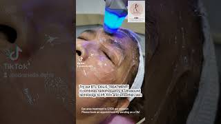 Effective nonsurgical eyebag removal and drooping eyelid treatment using BTL Exilis [upl. by Desirae]