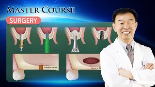 Master Course  SURGERY CAS Technique [upl. by Kostival]