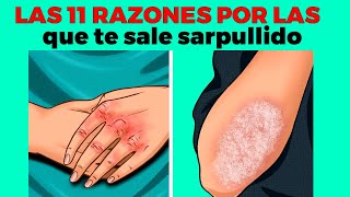 11 razones por las que te sale sarpullido o ronchas en el cuerpo [upl. by Betta955]