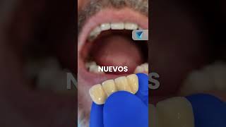 🦷✨ instalacion de corona definitiva el último paso para una sonrisa radiante implantesdentales [upl. by Lyret]