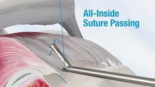 Spectrum® AutoPass™ Suture Passer  CONMED Product Video [upl. by Storer]