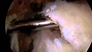 Arthroscopic Rotator Cuff Repair Surgery with SAD Dr Eric Janssen [upl. by Maguire]