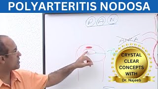 Polyarteritis Nodosa Clinical Features  Complications  Management [upl. by Oinotna836]