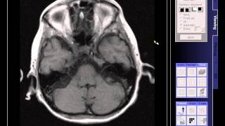 BRAIN MRI OLD INFARCTION [upl. by Eanyl999]