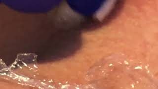 Skin Tag Removal During Plasma Pen Training By Plasmasthetics [upl. by Airetahs]