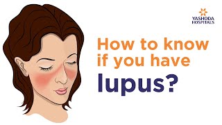 Systemic Lupus Erythematosus SLE Symptoms Diagnose And Treatment  Rheumatology [upl. by Mich990]