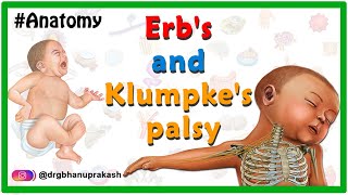 Erbs palsy and klumpkes palsy USMLE Animation  Etiology Clinical features Diagnosis Treatment [upl. by Richmond]