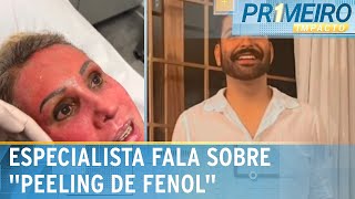 Dermatologista explica como funciona o “peeling de fenol”  Primeiro Impacto 040624 [upl. by Tnemelc999]