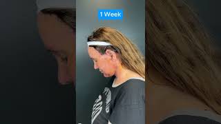 HUGE FACELIFT TRANSFORMATION 2 Week Update [upl. by Koffler929]