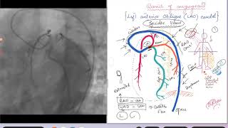 Coronary Angiogram LAO caudal Spider view [upl. by Helbonnah]