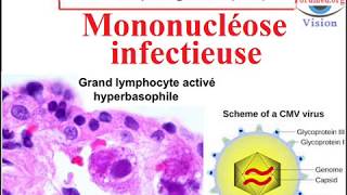 Infection à cytomégalovirus CMV Mononucléose infectieuse [upl. by Cheung]