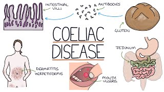 Understanding Coeliac Disease [upl. by Alebasi457]