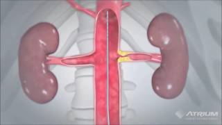 Aufdehnung einer verengten Nierenarterie mit Ballon und Einsetzen eines Stents [upl. by Henrie]