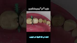 Sectional Matrix Application الكربولة dentist endodontics [upl. by Dammahum]