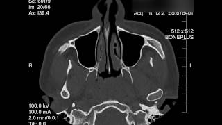 Deviated Septum Nasal CAT scan [upl. by Junie467]