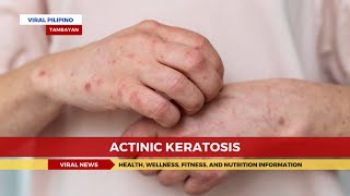 Actinic Keratosis [upl. by Assiruam]