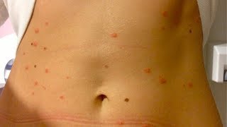 What is guttate psoriasis pictures symptoms stages photos and images [upl. by Eelano220]