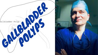 Gallbladder Polyps [upl. by Zadack]