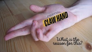 What is the reason for partial claw hand or ulnar claw hand ulnarnerve clinicalanatomy [upl. by Noeled]