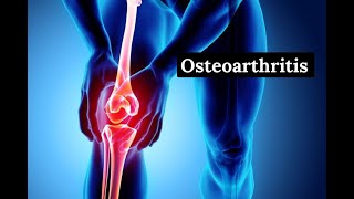 Osteoarthritis  Definition Causes Symptoms Diagnosis Treatment [upl. by Grassi]