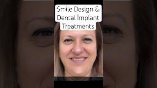 Smile Design dentalimplants smiledesign sidedentist sidedentalclinic manavgatdentist manavgat [upl. by Blum]