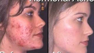 acne before after [upl. by Sungam]