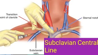 Subclavian Central Linecvpviral videoenglishtelugu [upl. by Bouchier]