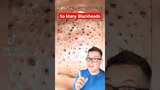 😲Most Blackheads I Have Ever Seen  BLACKHEAD REMOVAL shorts [upl. by Jo-Ann]