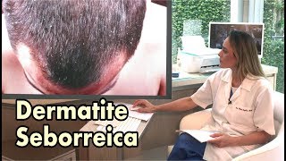 Dermatite Seborreica e Caspa  Conheça as diferenças [upl. by Annaiel]