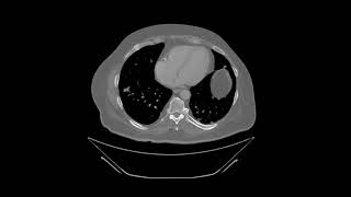 Bone Scintigraphy II  Introduction to Fractures and Metastases [upl. by Zanze560]