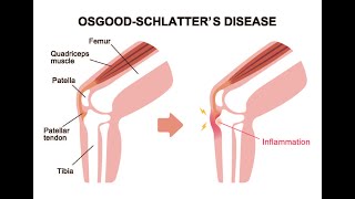 OsgoodSchlatter Disease  The Extra Point with Dr Scott Kleppe [upl. by Yerkovich]