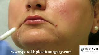 Dr Parakh  BOTOX Injection to the DAO muscle Corner of Mouth [upl. by Alahs838]