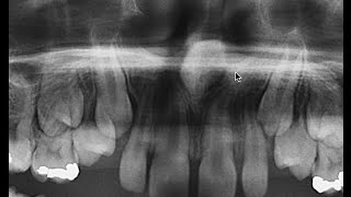 mesiodens evaluation radiographique CBCT TVFC orthodontie Sherbrooke 536931 CP10 [upl. by Buonomo]