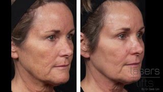 How long does it take to heal from CO2 laser resurfacing Fractional [upl. by Atela589]