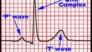 ECG QRS complex [upl. by Harland]