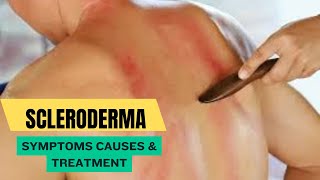 Scleroderma Symptoms Causes amp Treatment [upl. by Nauq969]