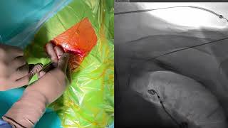 How to perform axillary vein puncture [upl. by Alpers188]