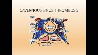 Cavernous Sinus Thrombosis PPT Slide Presentation [upl. by Cuthbert]