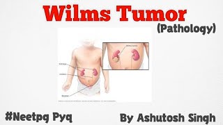 Wilms Tumor For 2nd year University Exams [upl. by Haela]